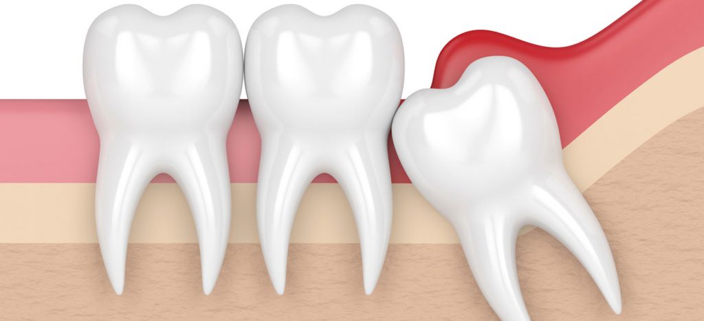 Problemas muelas del juicio clinica dental marti riera